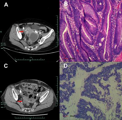 Positive response to niraparib in chemo-refractory patients with metastatic appendiceal mucinous adenocarcinoma harboring ATM mutations: A case report